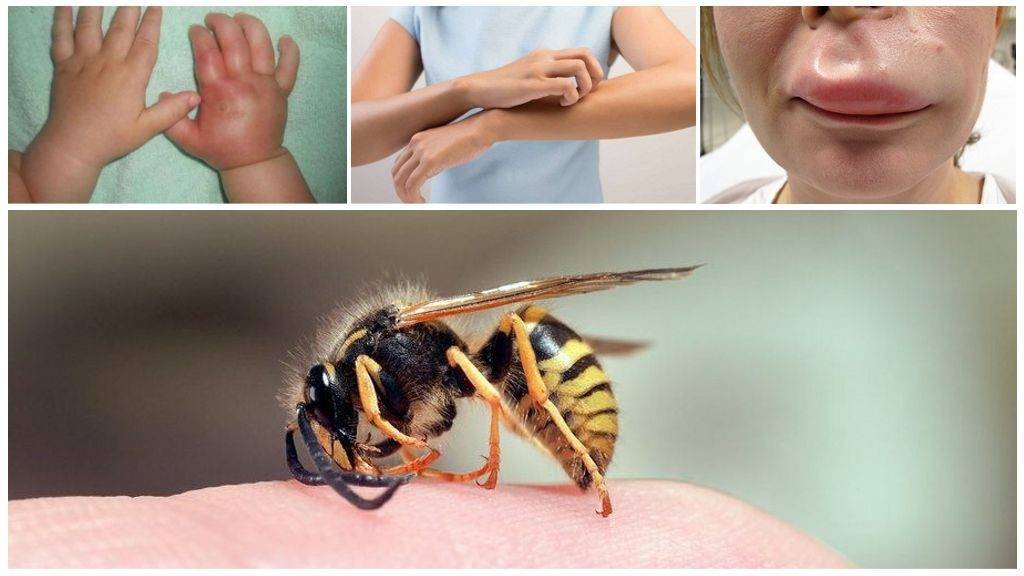 Укусила пчела: симптомы, первая помощь, как помочь и что делать, последствия укуса, профилактика