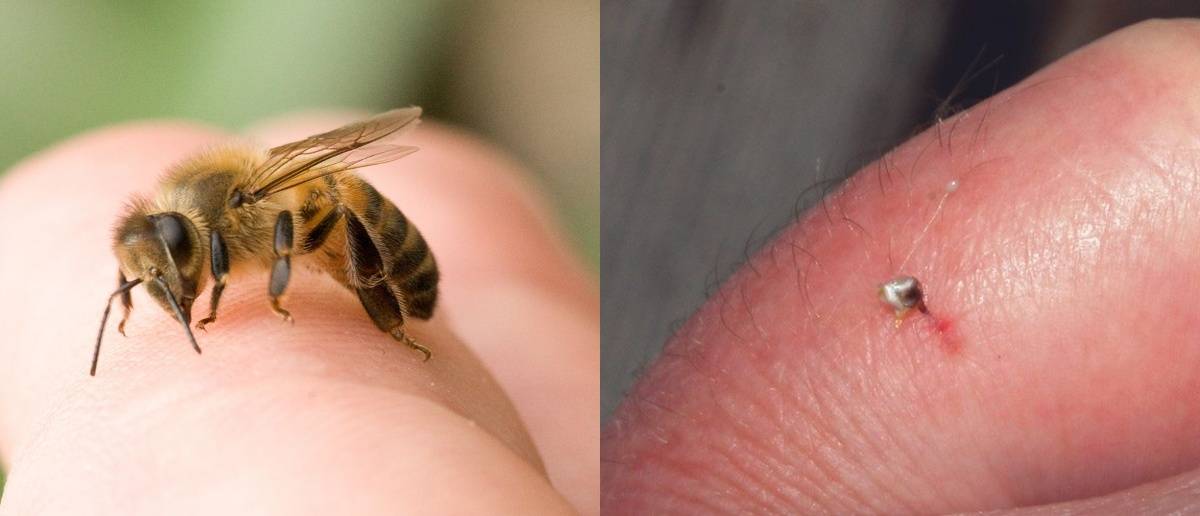 Что делать, если пчела укусила в губу