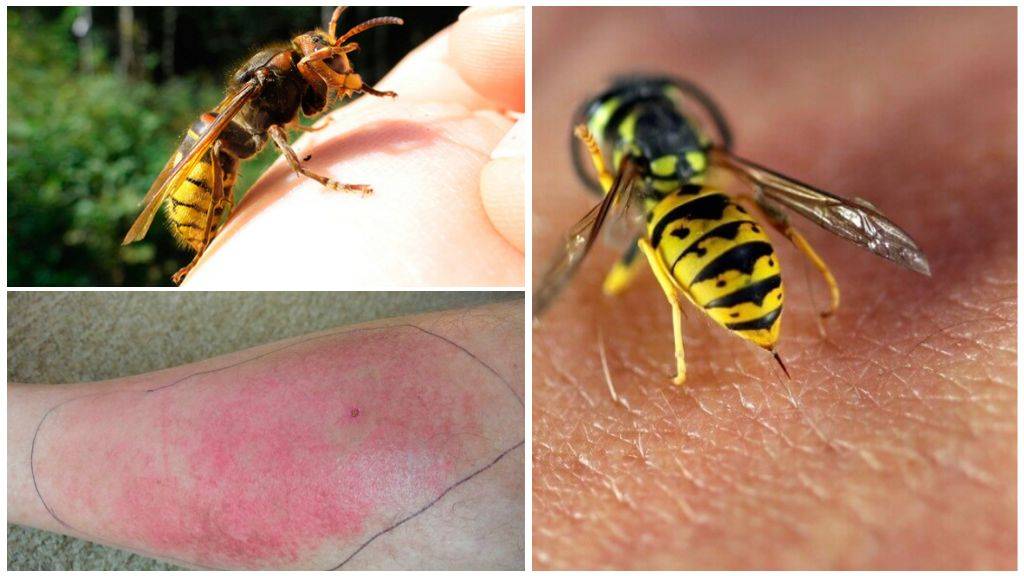 Укус шмеля и его последствия: что делать в домашних условиях, если укусило опасное насекомое?