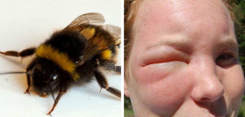Что делать при укусе пчелы