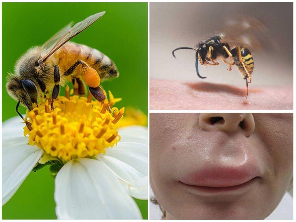 Если укусила оса, пчела, шмель, шершень - что делать, как снять опухоль ?
