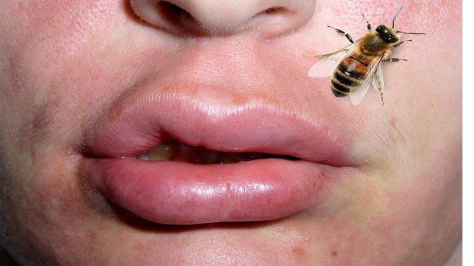 Реакции на ужаления насекомых - как проявляются и что делать?