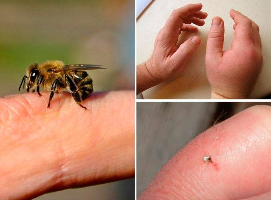 Что делать, если пчела ужалила в губу