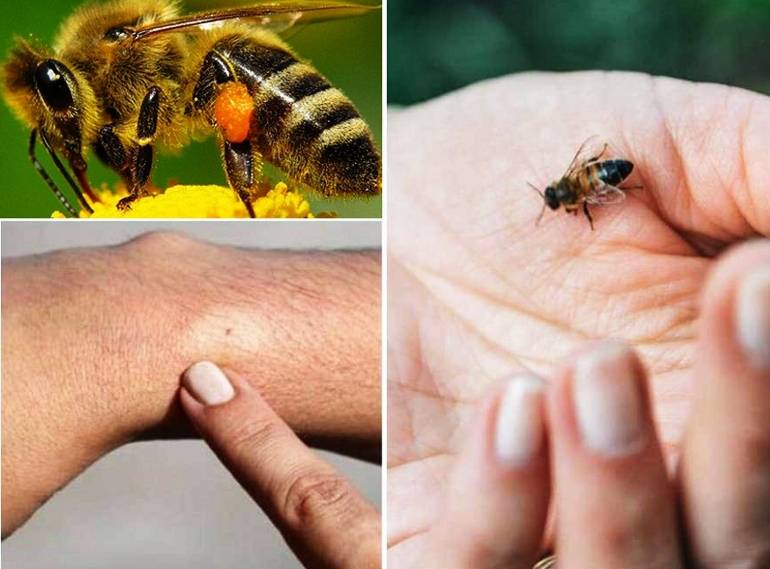 Аллергия на пчел