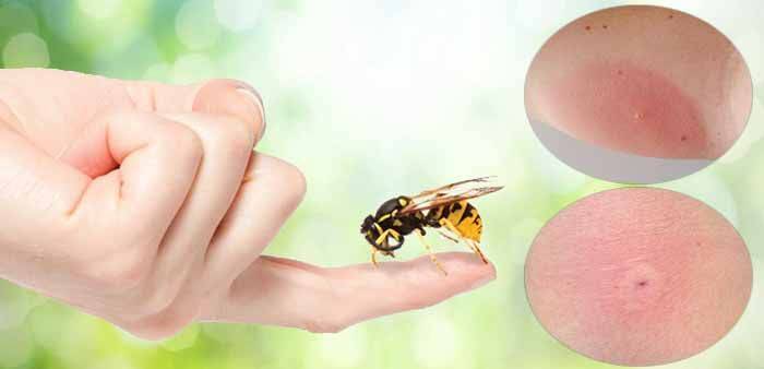 Чем снять отек от укуса пчелы на лице: симптомы, первая помощь